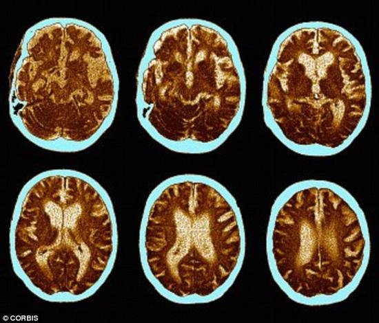 性生活频繁的老人出现痴呆的可能性更低。一项研究指出，规律的性爱活动能够帮助我们长出新的脑细胞。图为痴呆病人的脑部扫描。