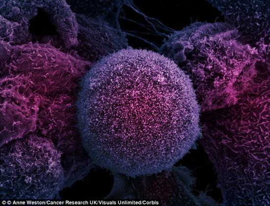 诺丁汉大学的研究人员发现，在五十几岁时还能保持规律的性生活的男性罹患前列腺癌的可能性更低。（图为显微镜下的前列腺癌细胞）。