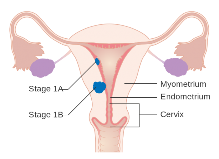 750px-Diagram_showing_stage_1A_and_1B_cancer_of_the_womb_CRUK_196.svg.png