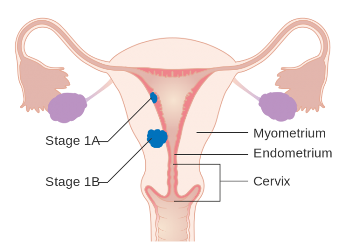 研究：体重过重的女性患子宫内膜癌的风险几乎高出一倍